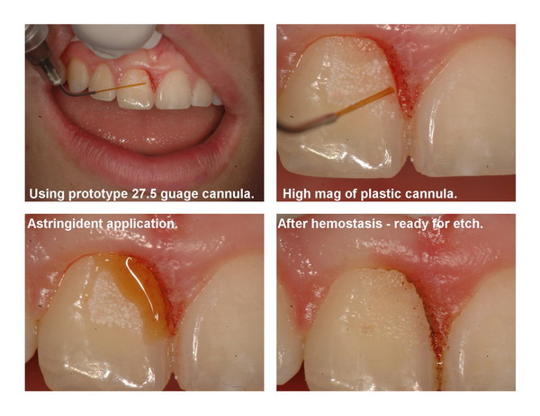 Gingivectomy and restoration Page6_resize.jpg